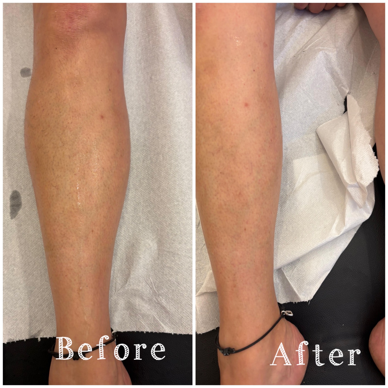 Lower leg wax, before and after
