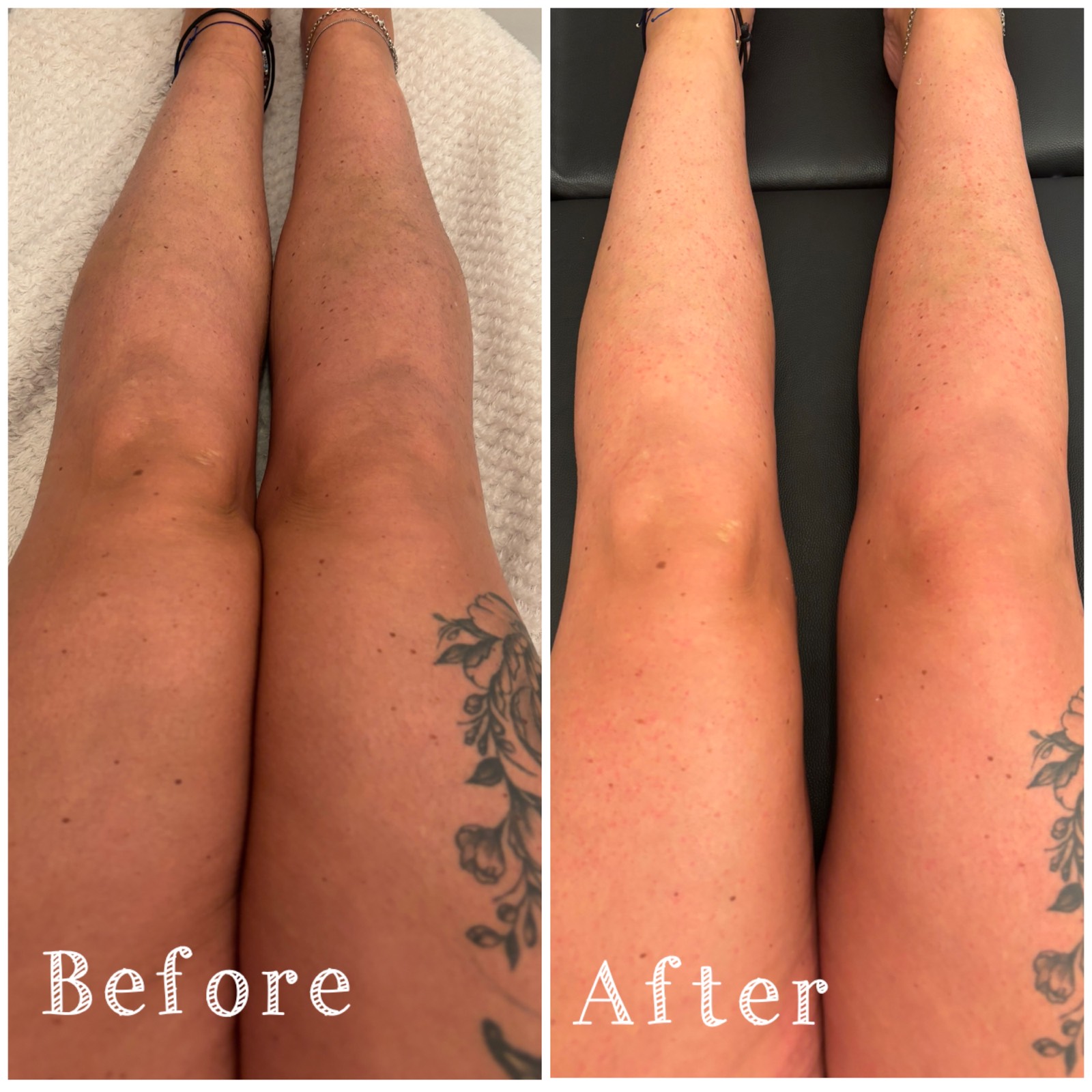 Full leg wax, before and after