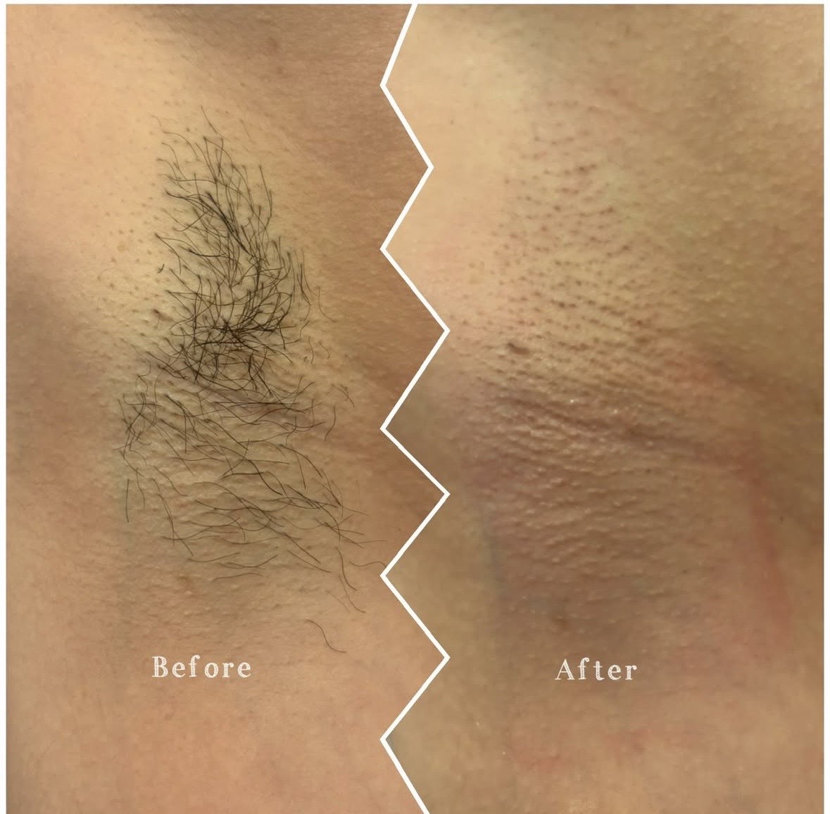 Underarm wax, before and after